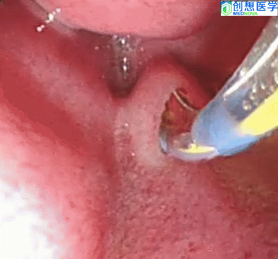 一次性乳头括约肌三腔切开刀